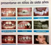 Problemas dentales en niños de 7 años