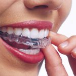 invisalign